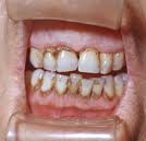 Лечение зубов